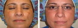 Cosmelan Depigmentation Treatment & Advantages