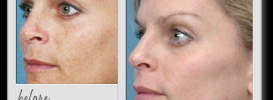 Hyperpigmentation Treatment