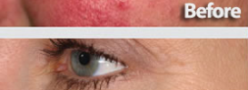 Pigmentation Removal Methods